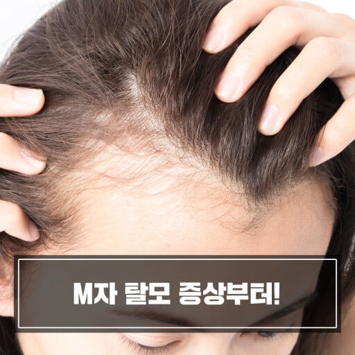 탈모 초기모습과 치료