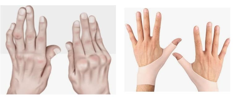 류마티스관절염과 퇴행성 관절염 구별하는 방법