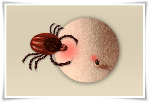 &quot;진드기&quot; 야외 활동의 숨은 적, 안전한 야외 활동을 위한 가이드!