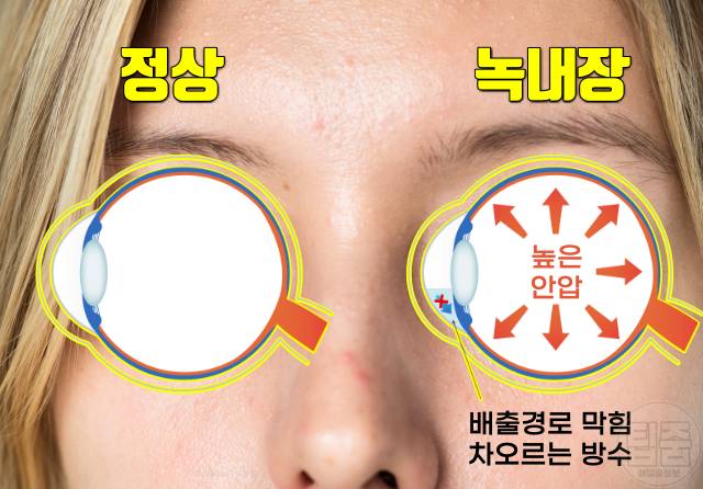 녹내장 원인 녹내장 실명확률 안압