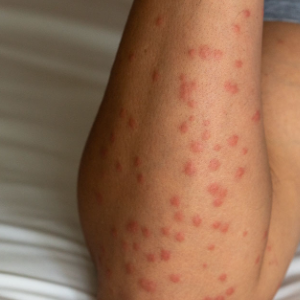 엠폭스 관련주 대장주 테마주 수혜주 TOP5