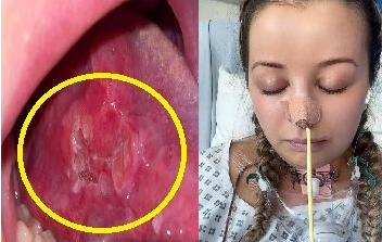 혀암 수술 후 회복 과정과 일상 변화 관련 이미지