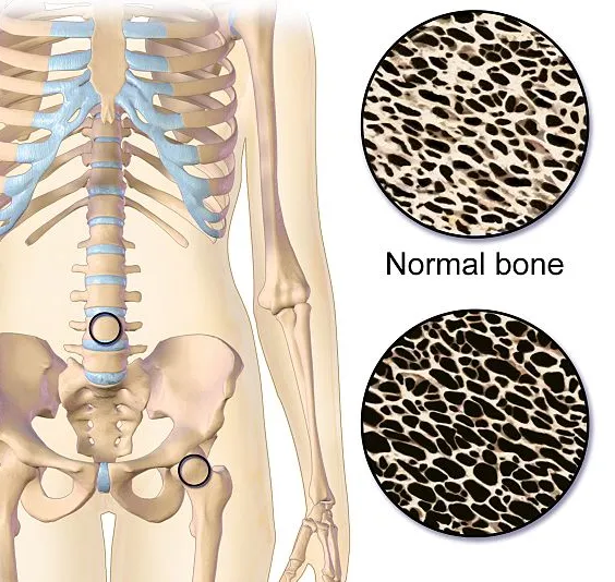 정상 뼈 골밀도와 골다공증 골밀도 비교
