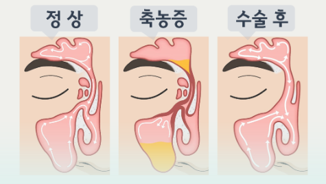 부비동염