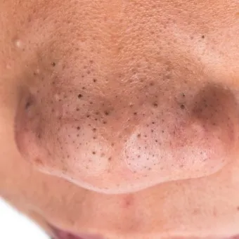 남자 얼굴 피지 제거 화장품 꿀템_31