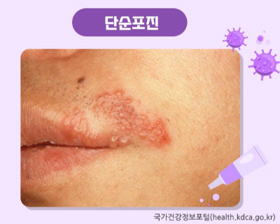 단순포진