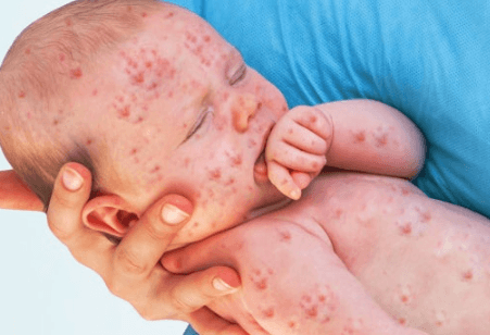 베트남 홍역 유행 유아