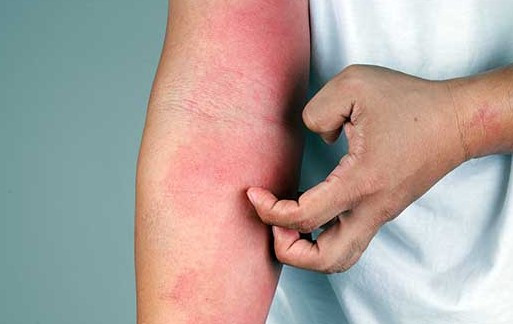 땀띠 치료 가라앉히는 방법 5가지 및 땀띠 대상포진 구별법 총정리