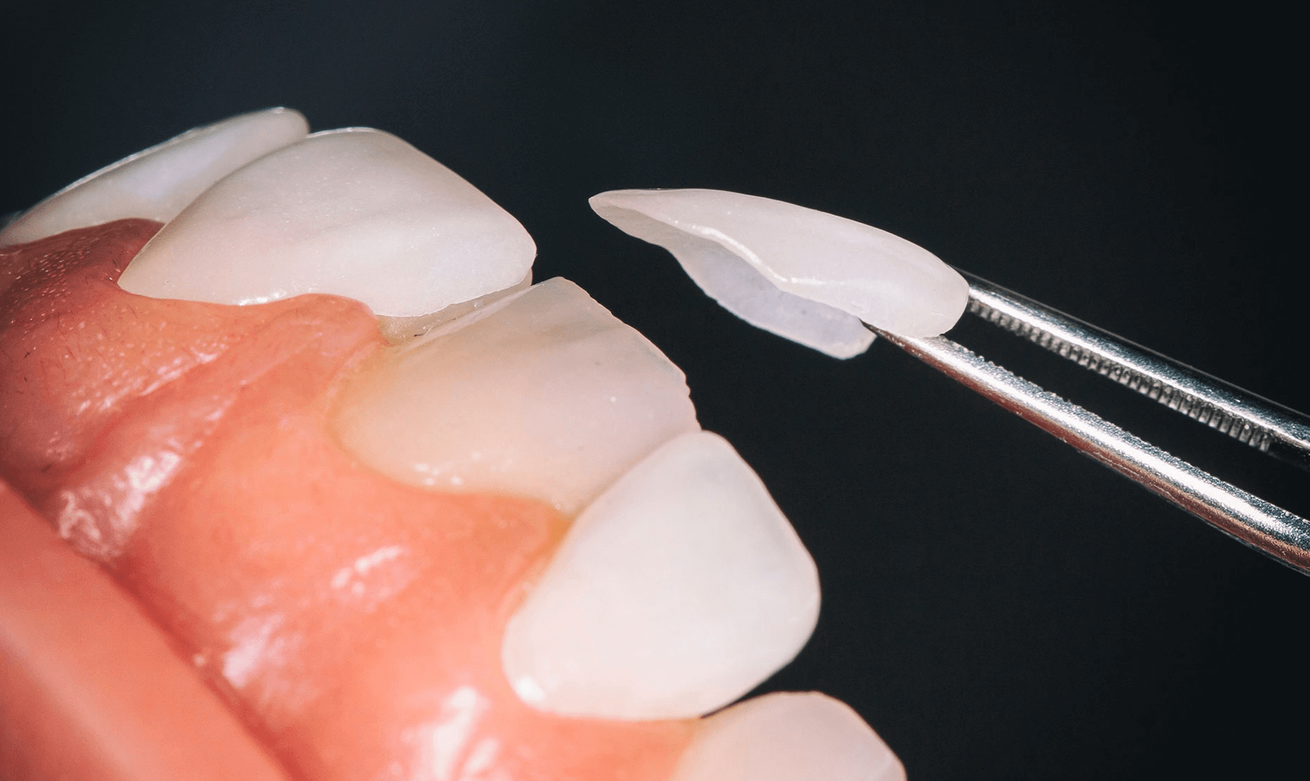 라미네이트 비용