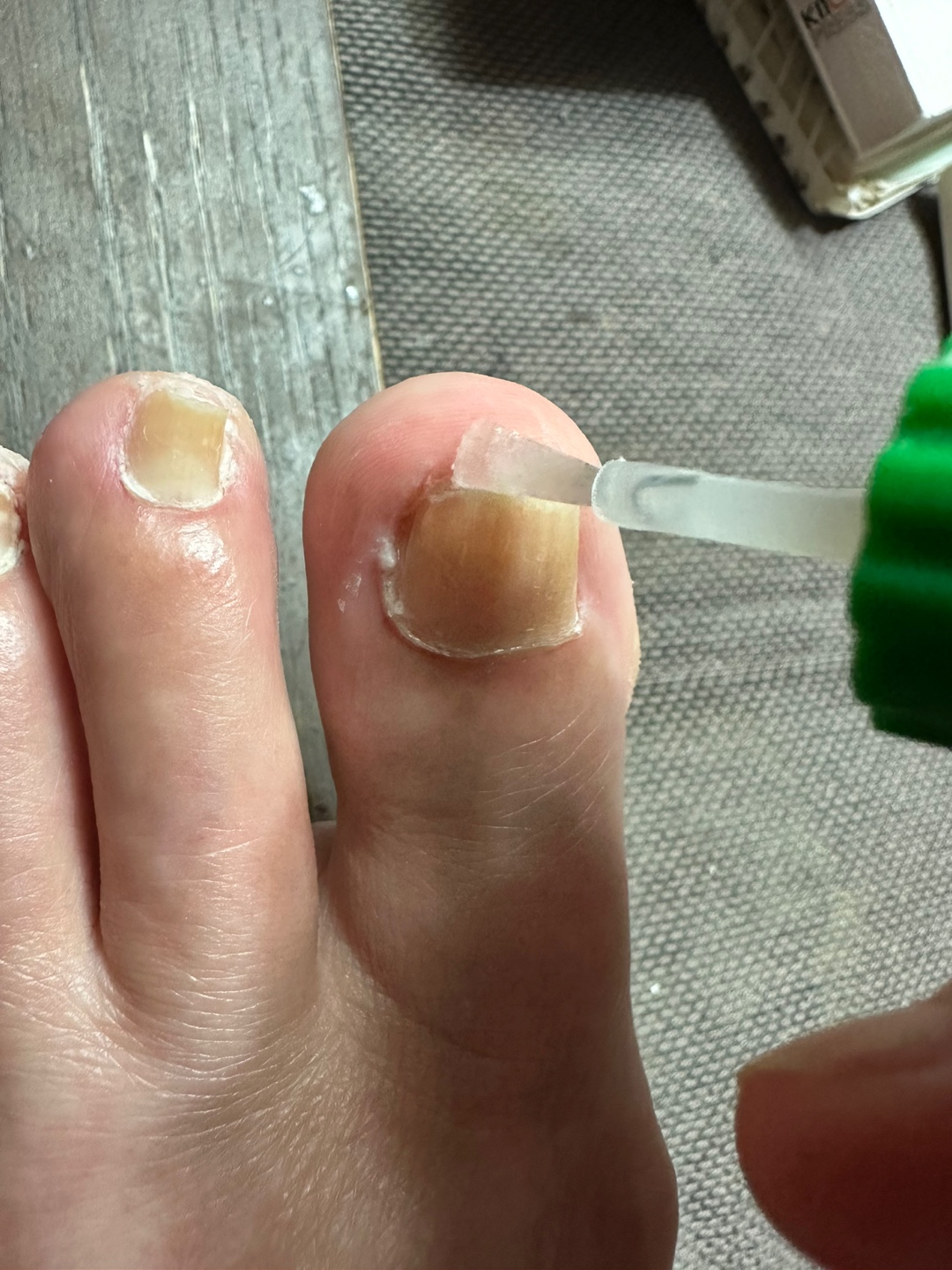 발톱 무좀&amp;#44; 왜 이렇게 잘 걸리고 안 낫는 걸까?