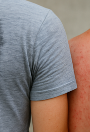 땀띠 가라앉히는 방법