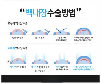 백내장 수술 비용 실비 보험 청구 회복기간_20