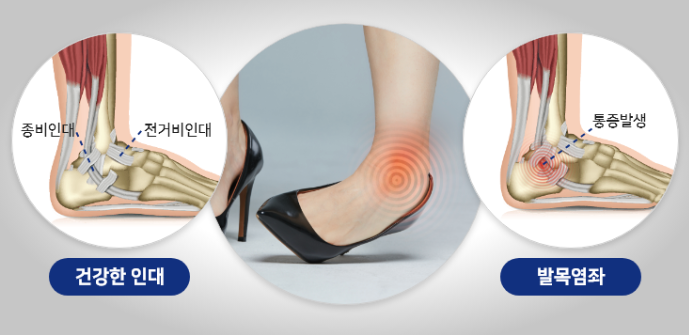 발목 염좌와 인대