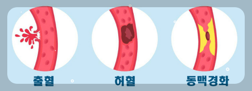 뇌출혈의 원인