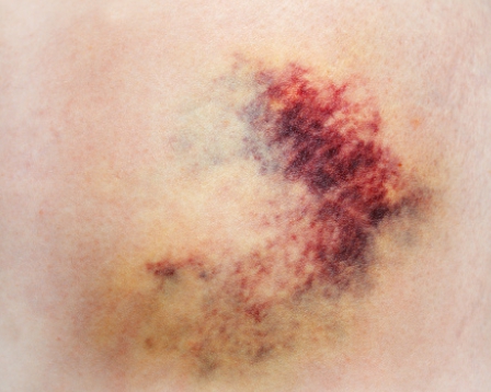 소론도정 부작용