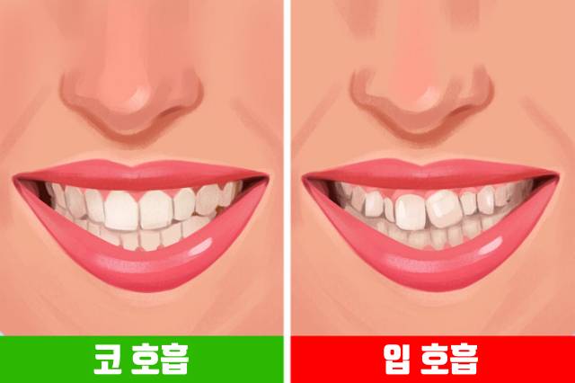 입으로 숨쉬면 얼굴변화 치아 부정교합