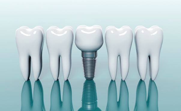 임플란트 가격
