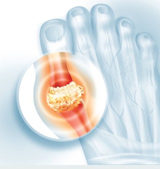 통풍 관리와 예방 방법 (식단, 운동, 생활습관)
