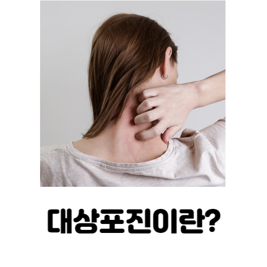 대상포진