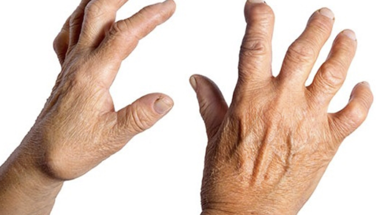 류마티스 관절염 초기증상 1