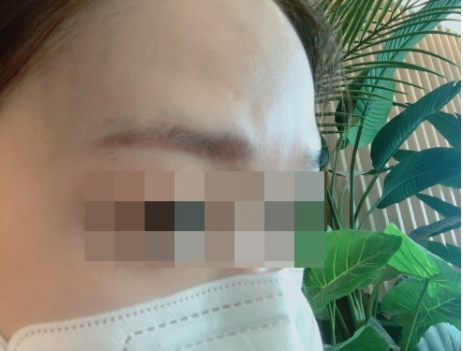 이마 미간 보톡스 후기2