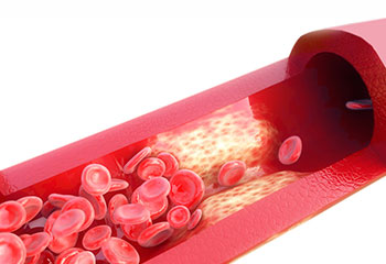 고지혈증-발병된-혈관