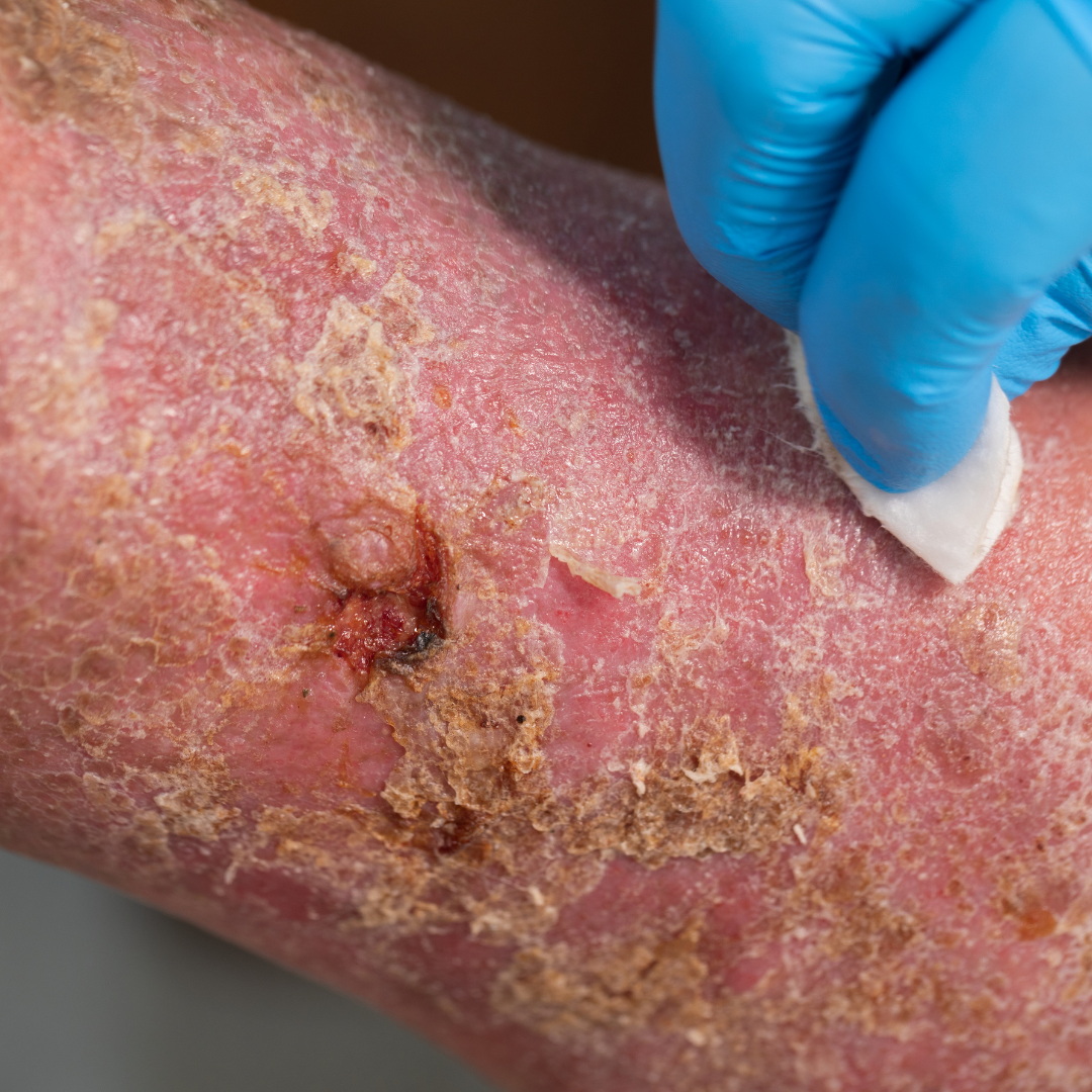 욕창 예방 치료 증상 원인