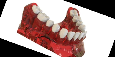 임플란트 가격 종류 비용