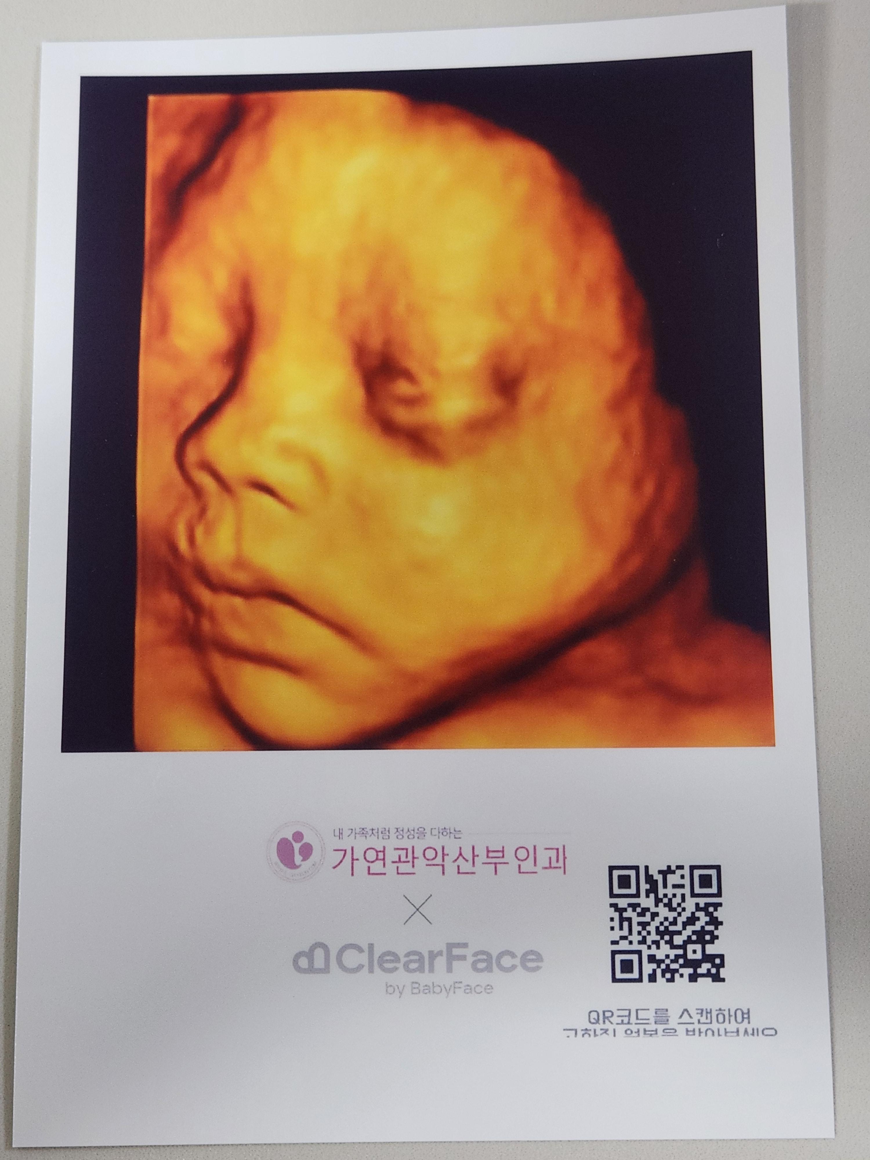 클리어페이스 입체초음파