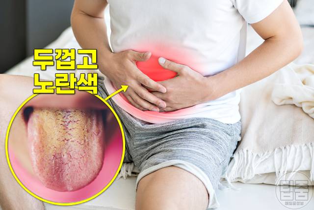 혀백태 원인 제거 혀 백태 안없어짐 위염 위암