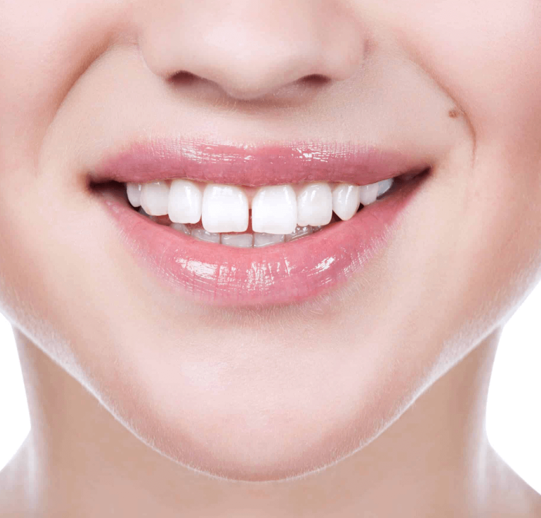 웃을때-앞니-벌어짐