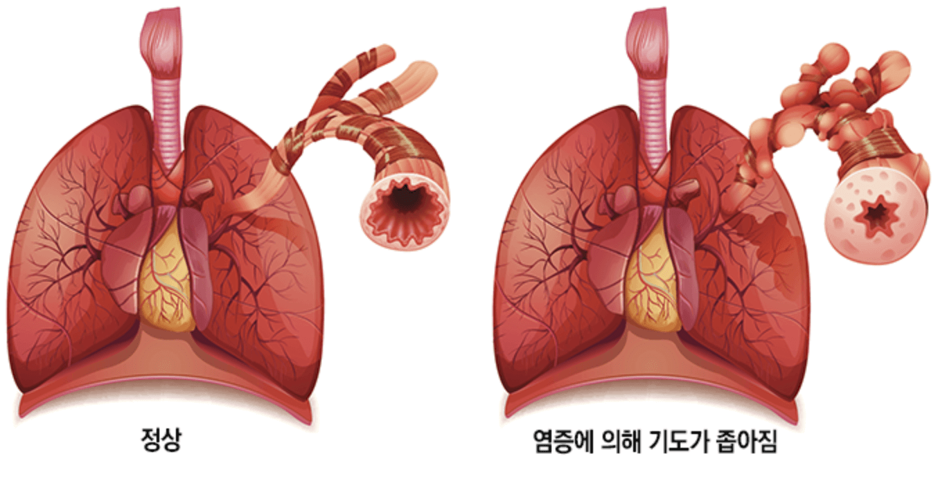 천식 기관지
