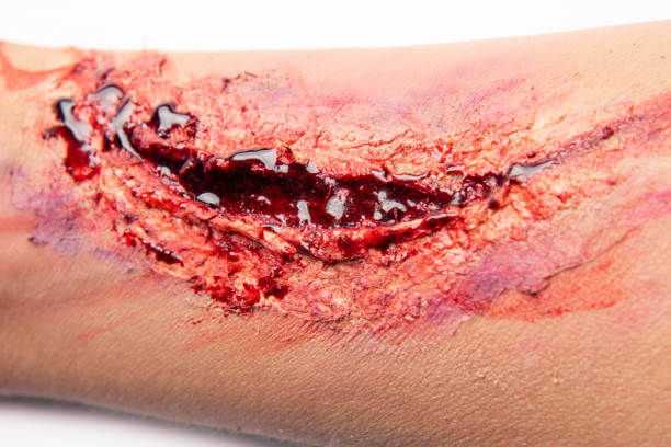 멍 빨리 빼는 법, 멍 드는 과정과 색깔. 멍을 빨리 빼는 방법은 염증을 완화시키고 치유 과정을 가속화하는 다양한 방법들을 포함하고 있습니다. 멍이 생기면 지금 당장 대응하는 것이 중요하며, 올바른 방법을 통해 치료하면 멍의 기간을 단축시킬 수 있습니다.