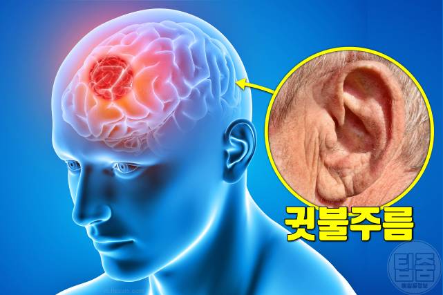 귓불주름 귓볼주름 치매 귓볼이 접히는 증상