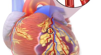 심혈관 질환 전조증상