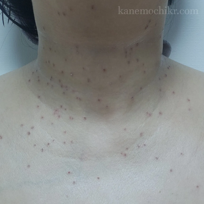 쥐젖-제거후-모습