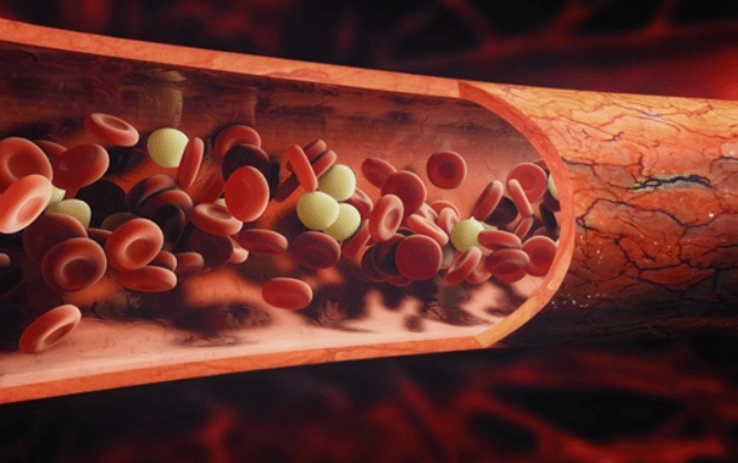 고지혈증-혈관에 콜레스테롤이 쌓여 있는 모습을 형상화한 이미지
