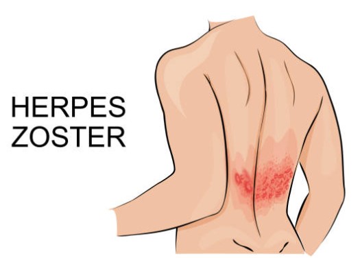대상포진 초기증상 완벽정리 (통증, 발진, 구분법)