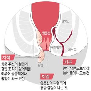 질출혈