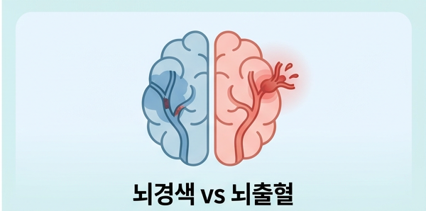 뇌경색과 뇌출혈, 어떻게 다른가