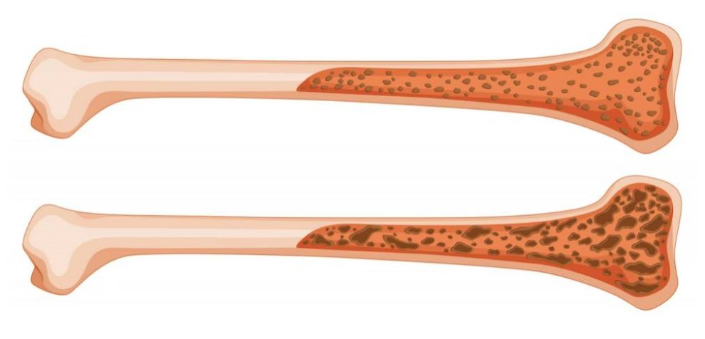 남성 갱년기 증상