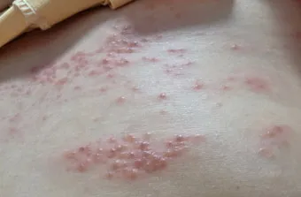 경기도 대상포진 무료접종 연령 기준 정리로 안내_9