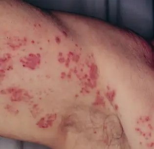 대상 포진이란 무엇인가요?