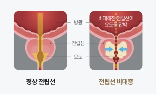 전립선이 커지면서 소변길(요도)을 막는 모습을 직관적으로 보여주는 이미지