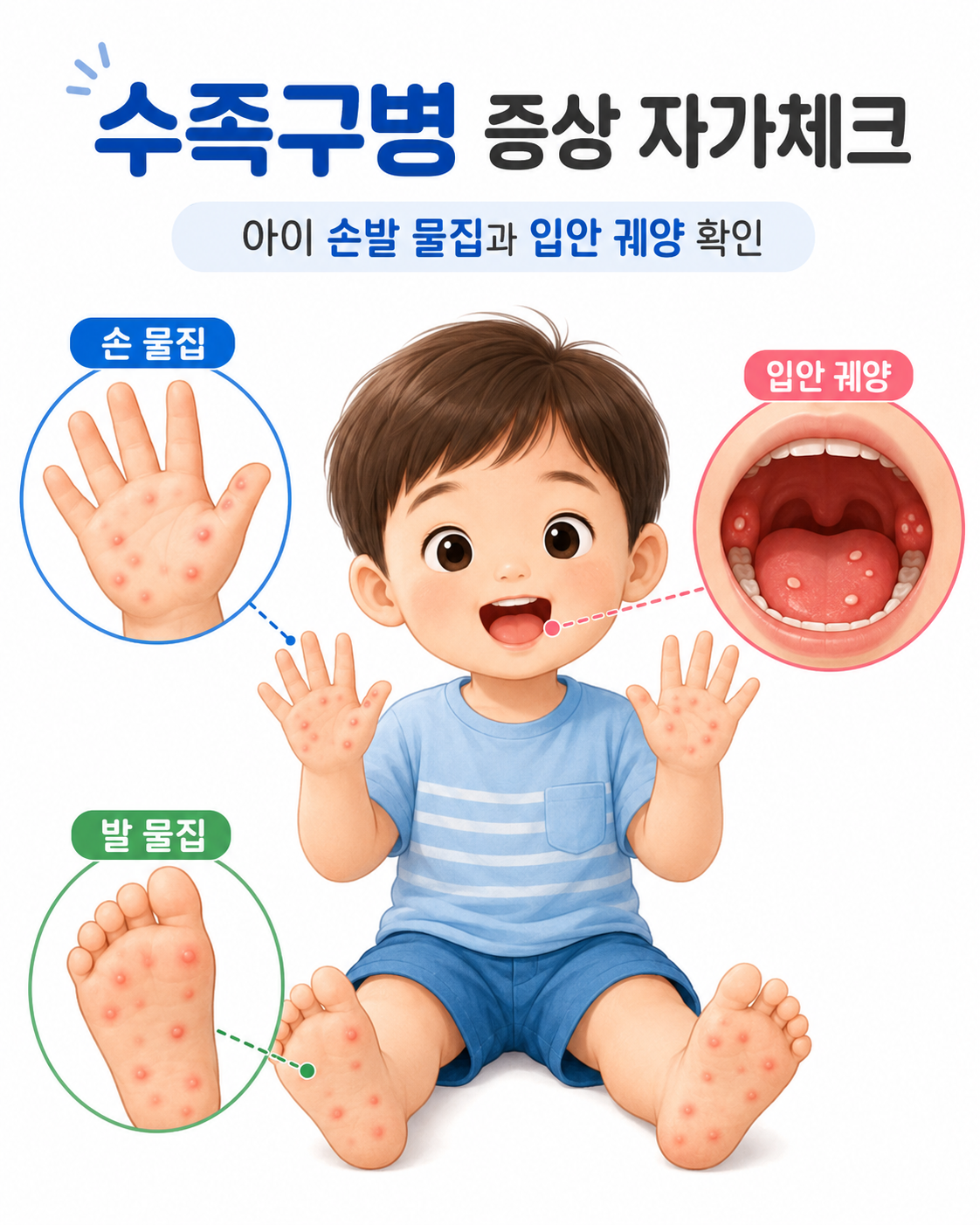 수족구병 증상 자가체크 — 아이 손발 물집과 입안 궤양 확인