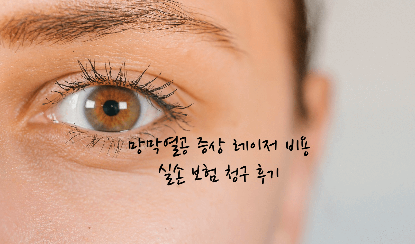 망막열공