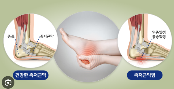 족저근막염 치료