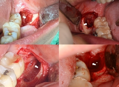 사랑니 발치 후 식사 가이드