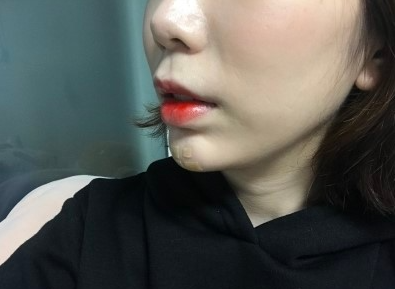 이중턱 보톡스 후기