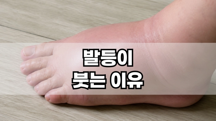 발등이 붓는 이유